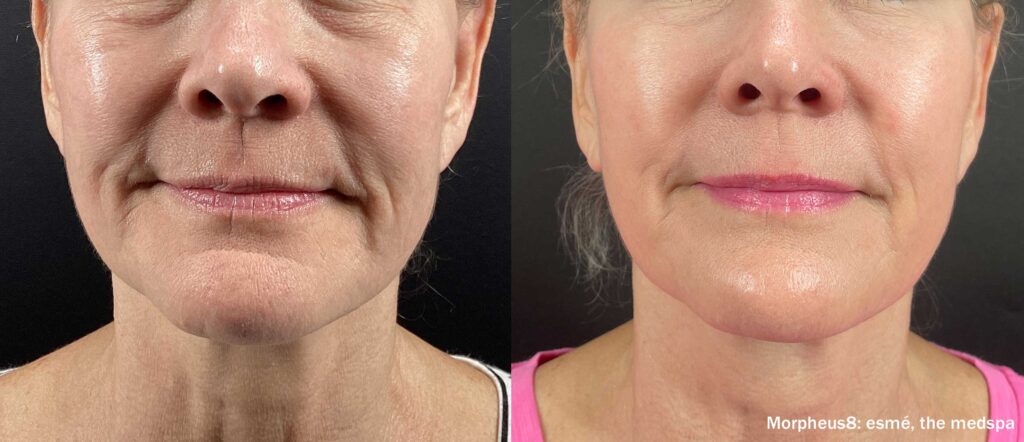EsmeMedspa_Morpheus8_Before_After_4Treatments_Front-TM