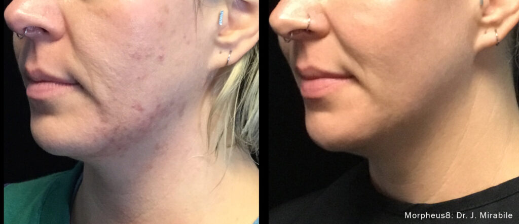 JM_Morphues8_Before_After_TM-LeftSideChin