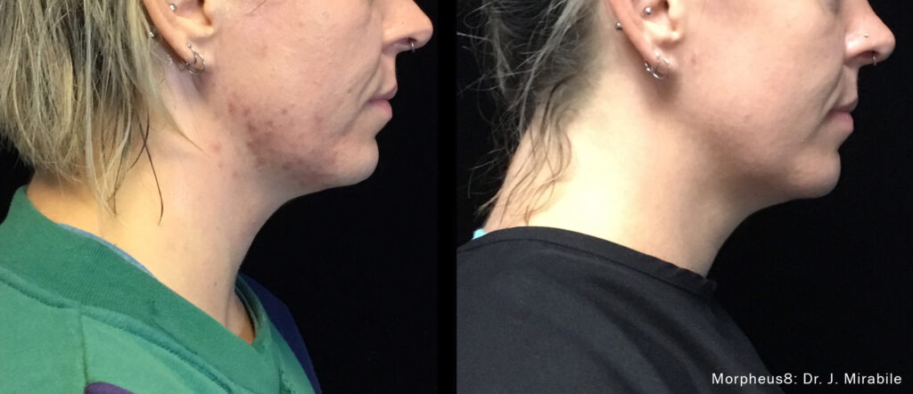 JM_Morphues8_Before_After_TM-RightSide