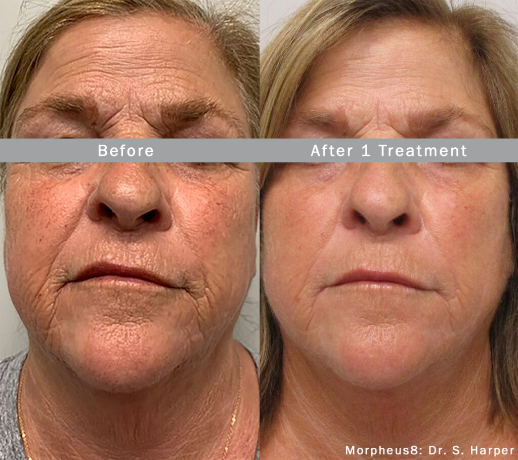 morpheus8-before-after-dr-s-harper-preview-2